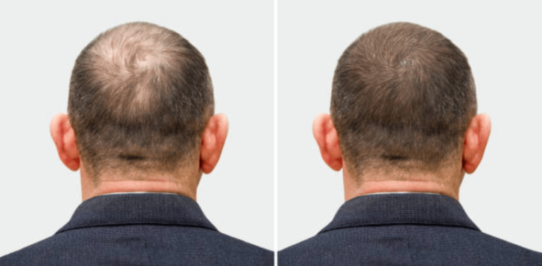 Innovative Hair Loss Solutions and Expert Care in Essex