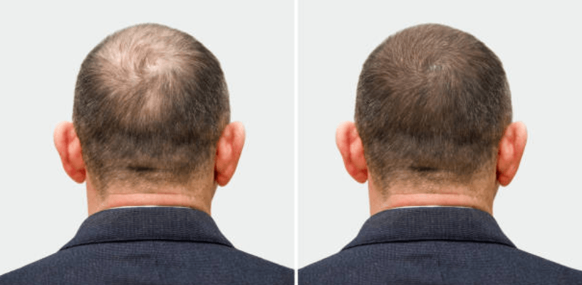 Innovative Hair Loss Solutions and Expert Care in Essex